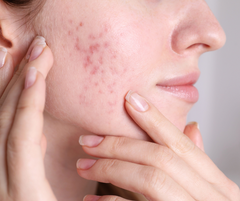 Can Tallow Help With Acne Scars by Supporting Collagen Repair?
